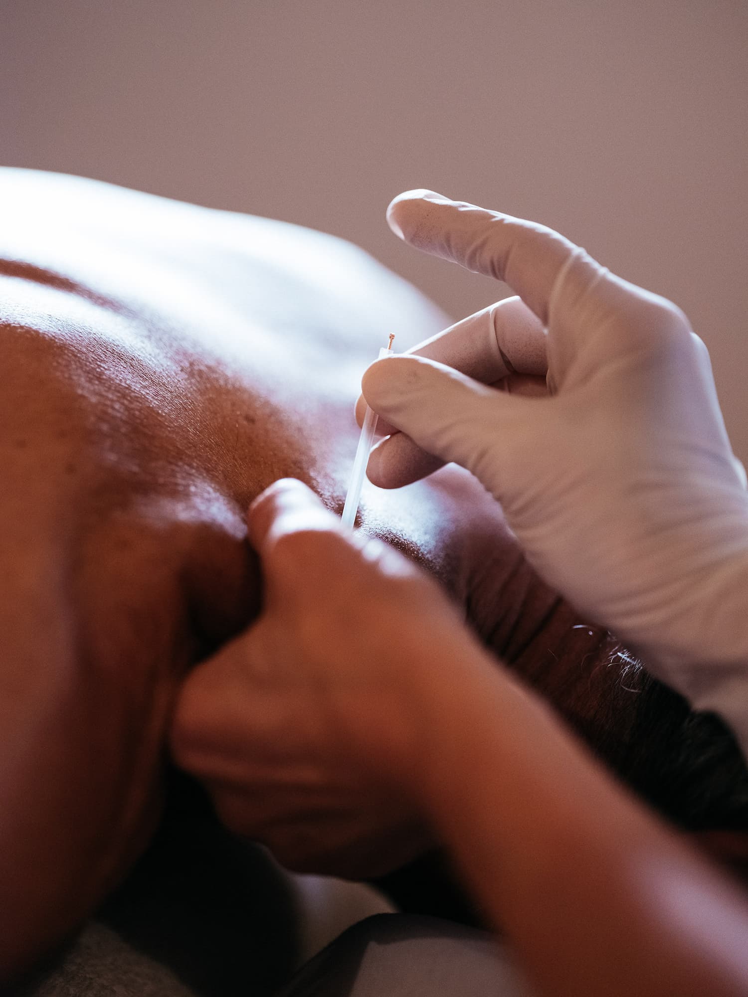 A theraputic needle being applied to the pinched skin of a man's shoulder.
